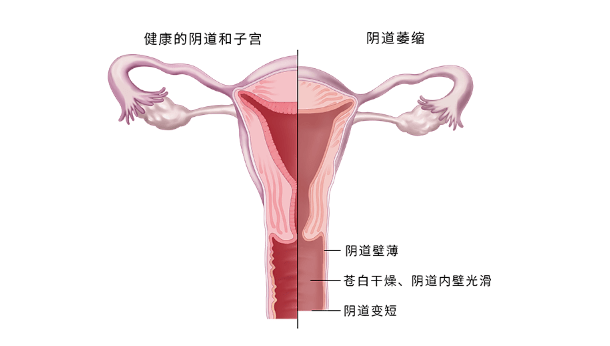 外阴疼痛，痛到几乎抑郁！女性难以启齿的痛楚，有谁知道？