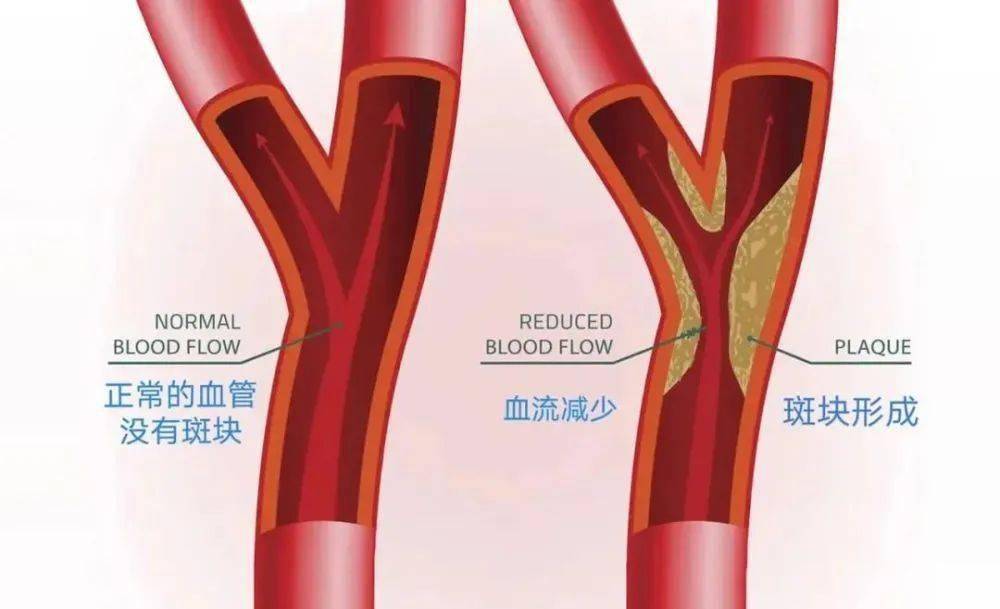 原标题：【医文医话】心内一科：关于颈动脉斑块，您了解多少？