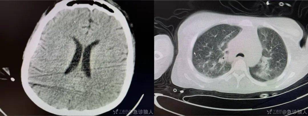 年轻女子不明原因「酸中毒」，竟在血液里发现了那个药（近期高发）