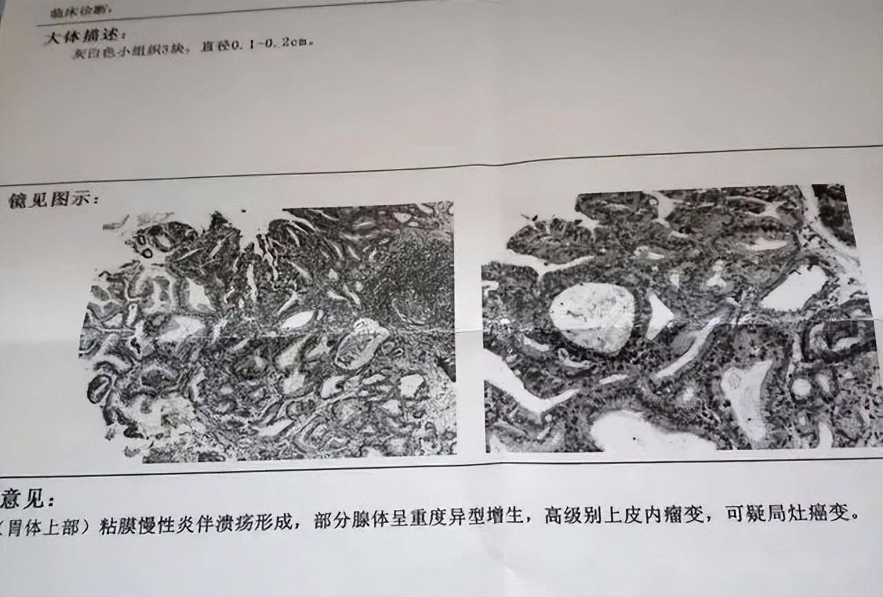 57岁男子萎缩性胃炎伴肠化，5年不治疗不复查，再查已经癌变