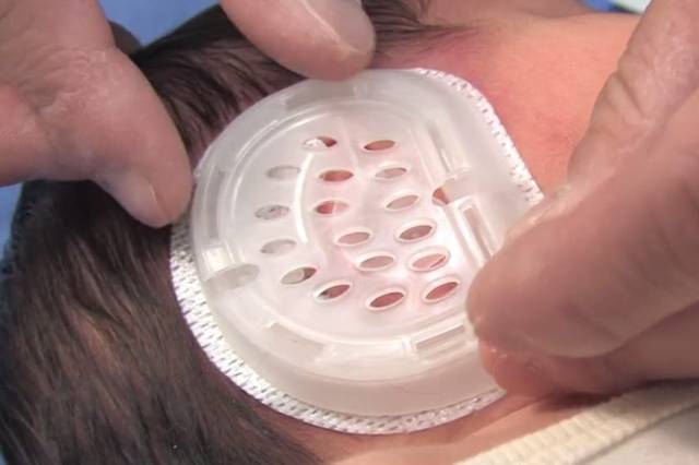 【全球最新爱韦尔研究荟萃】—新加坡医生团队前瞻性研究