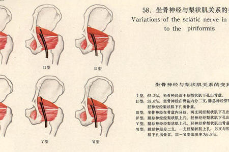 零力度无痛正骨坐骨神经痛梨状肌综合征的诊断张振听