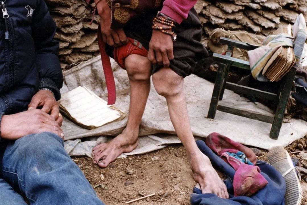 原创 发现171年至今病因未明,它让百万人关节畸形甚至变成侏儒