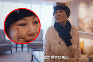 张蔷自曝割眼袋手术失败