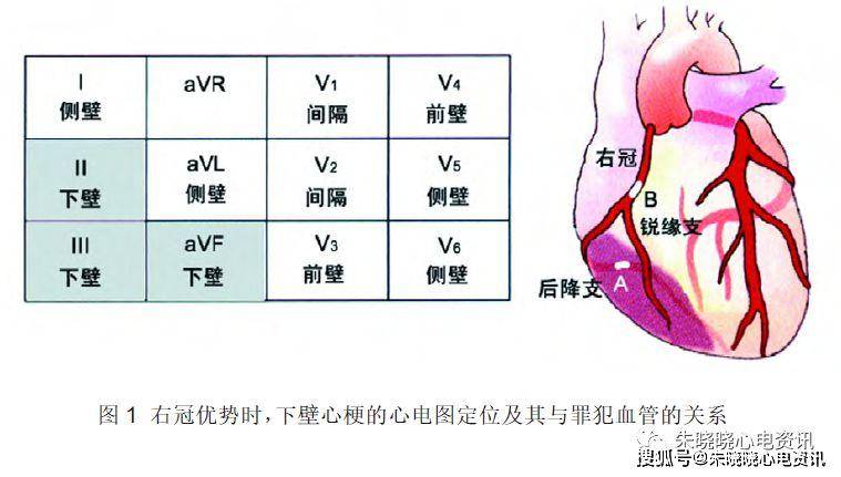 心梗位置判断 图图片