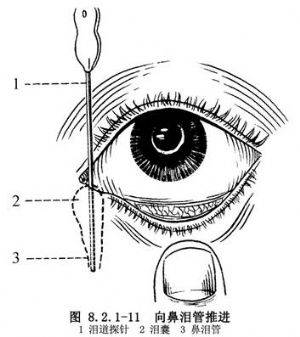 【科普】婴幼儿眼屎多,遇风流泪,可能是泪腺堵塞了!_泪道