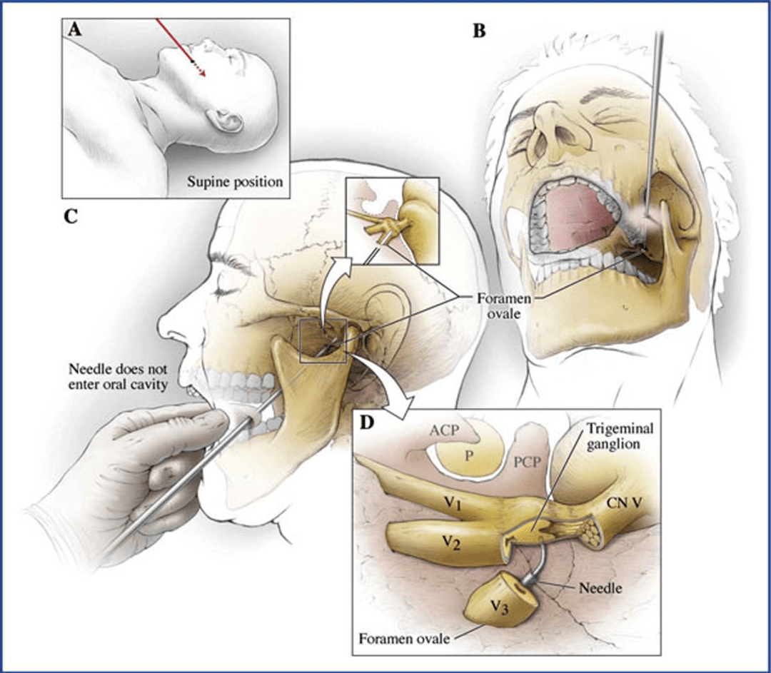 九江市中医医院脑病科成功实施一例经皮卵圆孔穿刺三