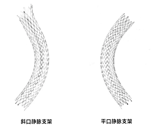 髂静脉支架植入术图片