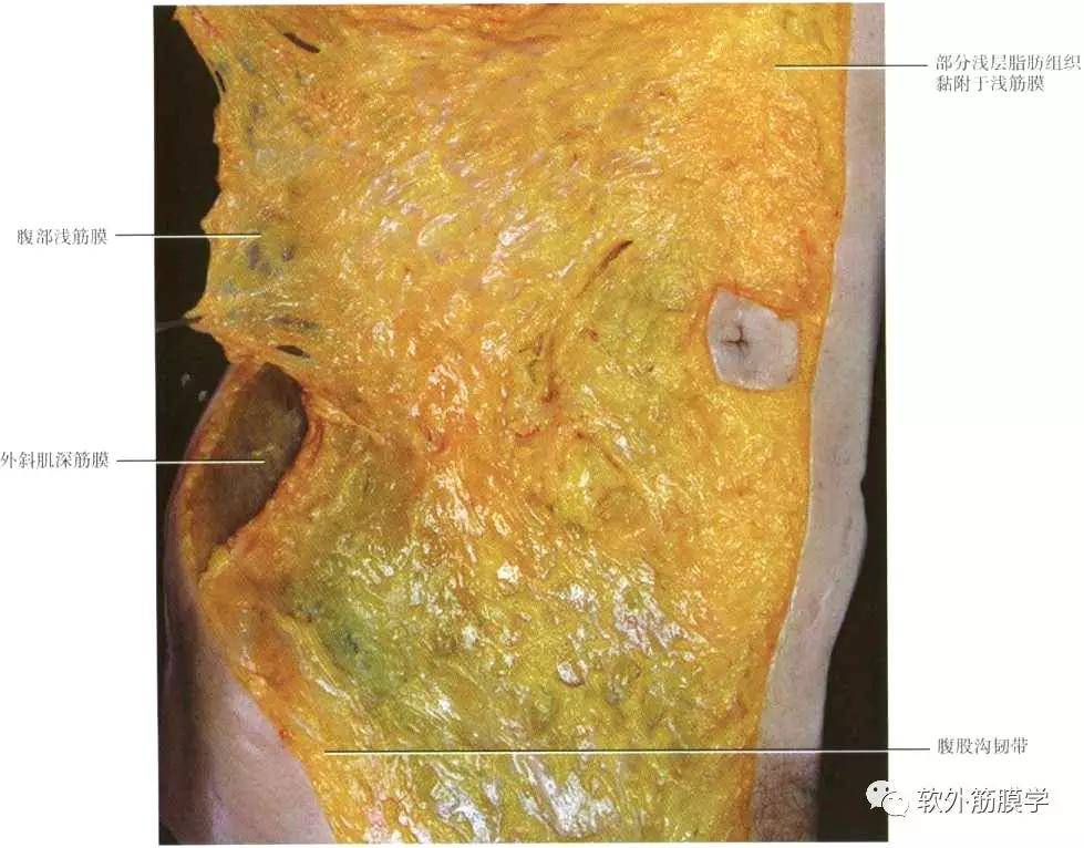 腹壁浅筋膜图片