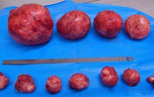 女性子宫肌瘤究竟长啥样宫茹清健康顾问带您了解一下