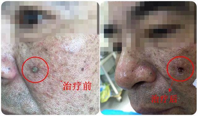 老人脸上长“羊角”?医生:这是皮角_市第三医院