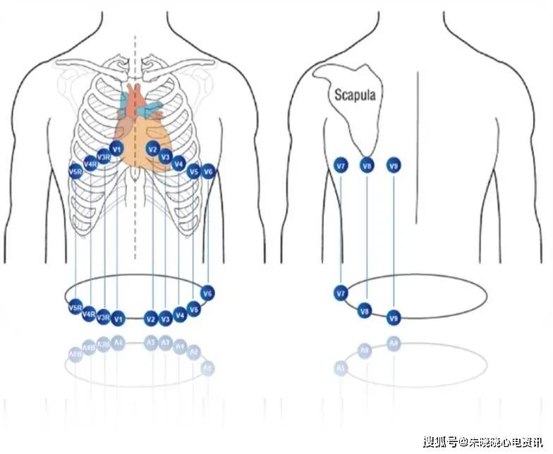 而12导联心电图只能对心脏前壁,前间壁及下壁的病变进行准确定位,但正