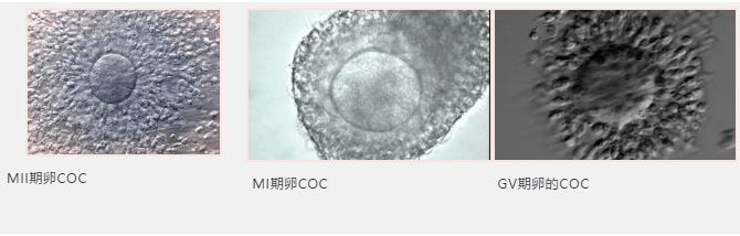 階段,取卵後培養師立即對卵丘-卵母細胞複合體的形態進行評估和分期