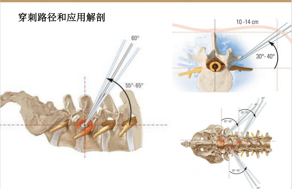 【收藏版】椎间孔镜技术脊柱应用解剖图表