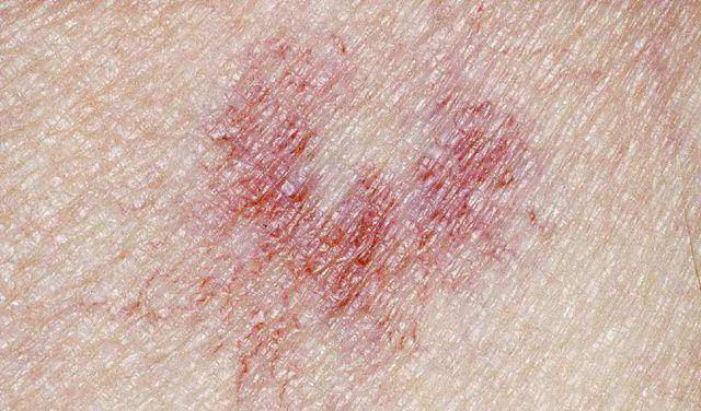 蜘蛛痣,面颈部,胸前部,肩部和上肢手背等上腔静脉所流经的皮肤区域