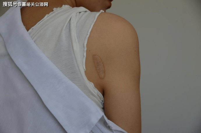 嘉峪关美容变噩梦少女肩脖被烫伤终身留疤痕