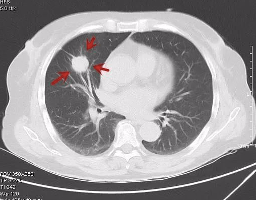周围型肺癌ct表现图片图片