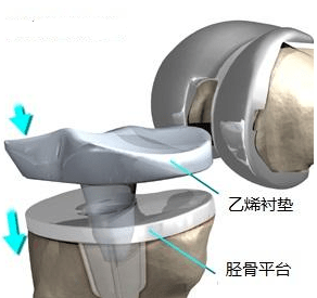 人工膝关节通常由特别耐磨的钴铬钼合金制成,大部分都是用骨水泥固定
