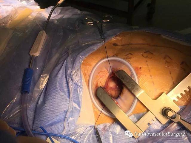 上海六院励峰教授团队成功实施首例经心尖tavi_手术