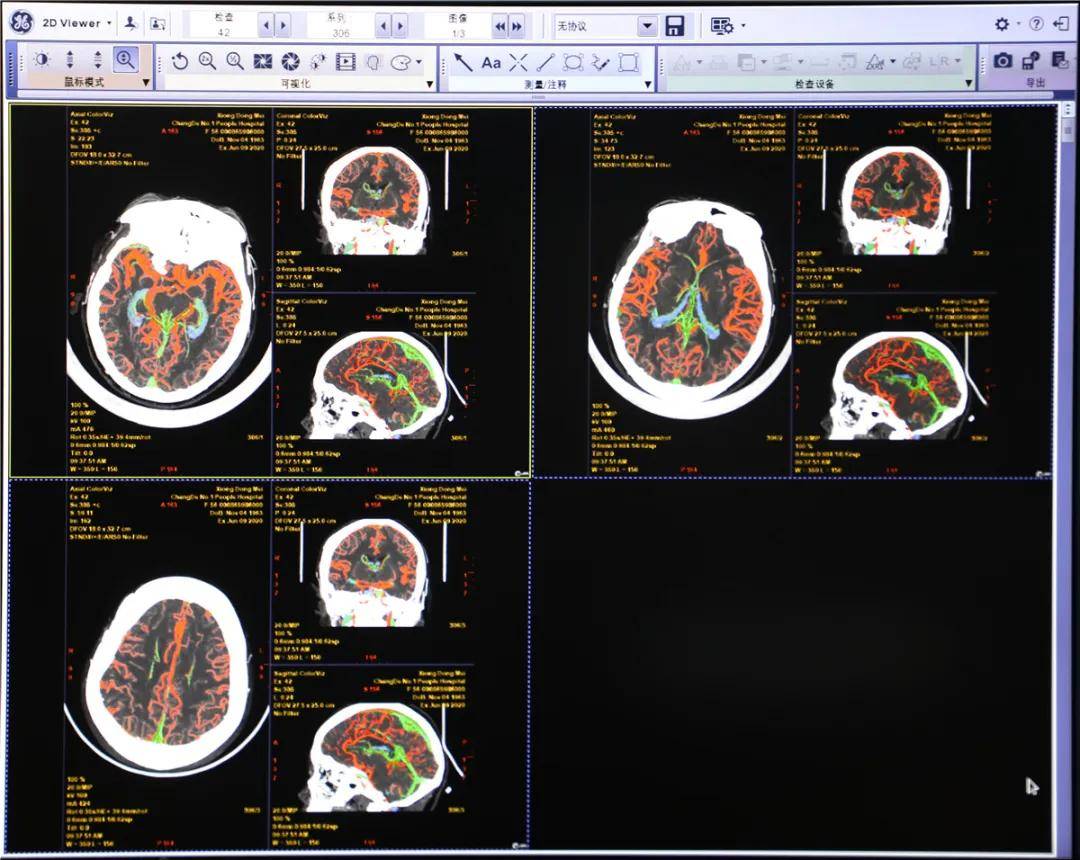 动态颅脑头部cta
