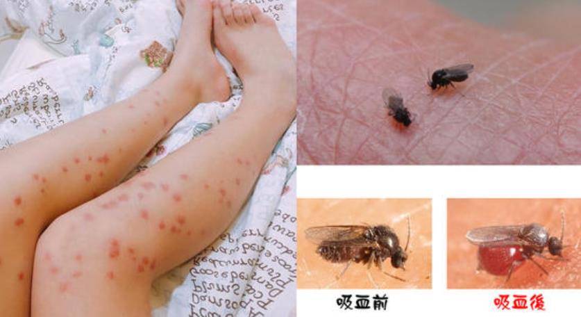 疫情宅在家假日公园放风小心虫虫危机叮咬怎么办