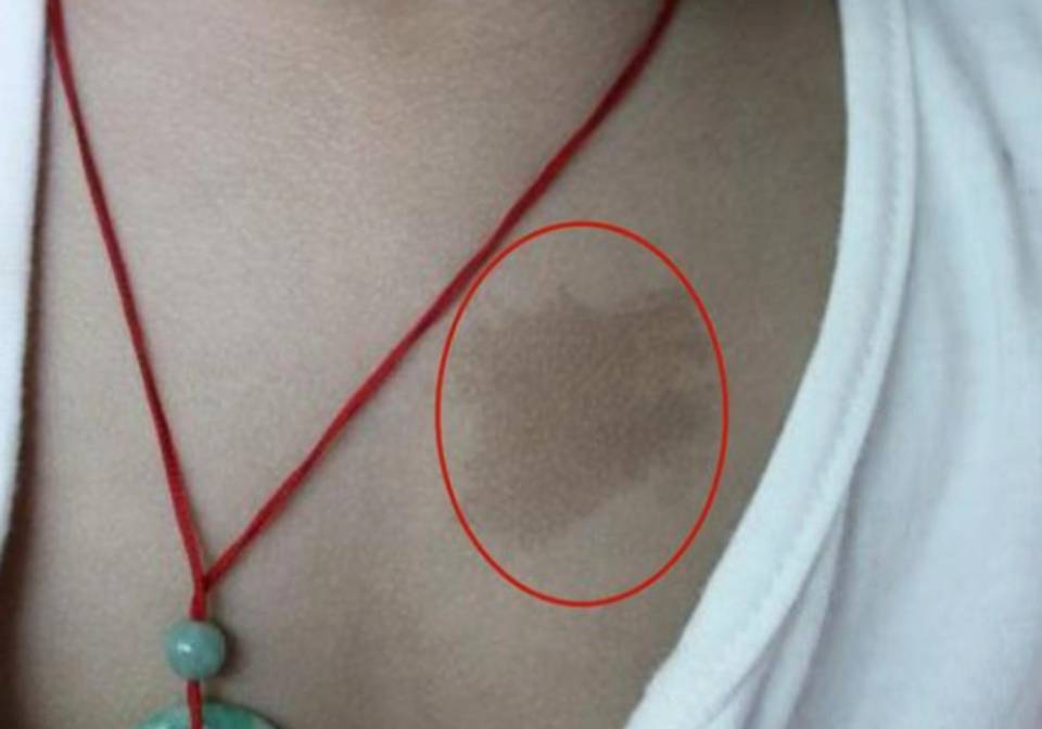 胎记暗示"前世死法"?网友评论逗乐众人,医生笑骂:都是谣言