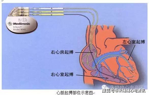 手捏心脏起搏图片