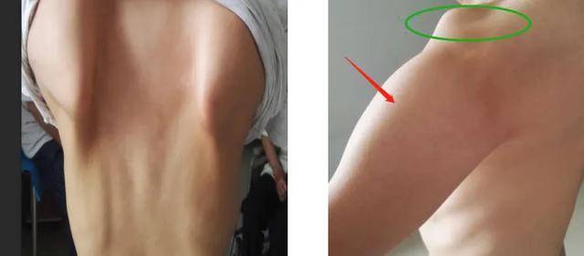 进行性肌营养不良症是一种原发横纹肌的遗传性疾病.