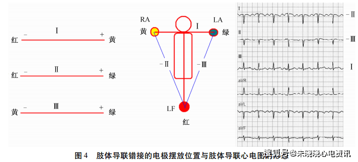 圖解肢體導聯電極錯接的心電圖表現