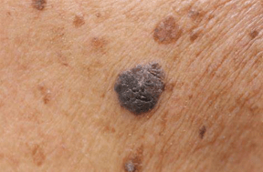 "人活一张脸,树活一张皮",关注hiv感染者的皮肤健康