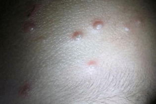 "人活一张脸,树活一张皮",关注hiv感染者的皮肤健康