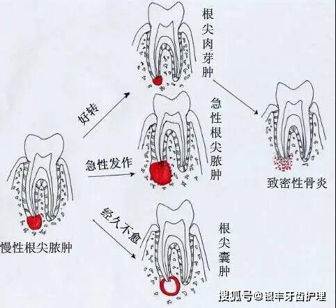 乳头龈牙结合部堆积的牙菌斑及其中的有害物质长期作用于牙龈引起炎症