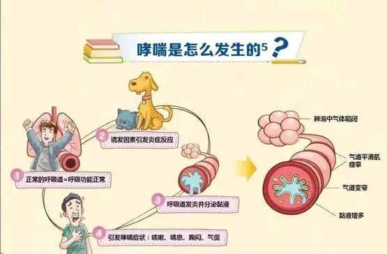 【疾病科普】哮喘的发病症状具体有哪些表现?