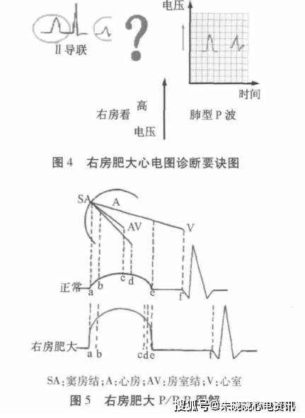 心房心室肥大的心電圖診斷