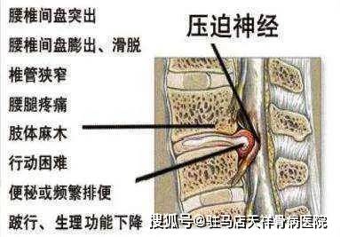 棘上韧带炎位置图片