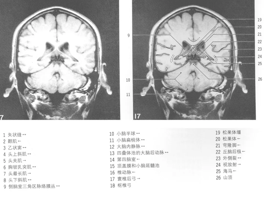 影像基礎mri顱腦冠狀位解剖圖譜