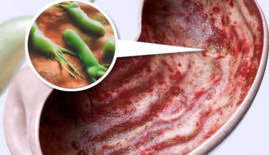 胃有幽门螺杆菌?不要慌,常吃6种食物,排毒灭菌,赶走老胃病!