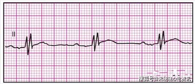 临床常见14种异常心电图的波形特点,收好