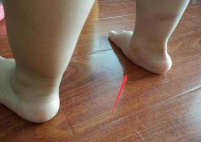 儿童脚变形严重图片图片
