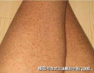 鱼鳞病需要治疗吗?_症状