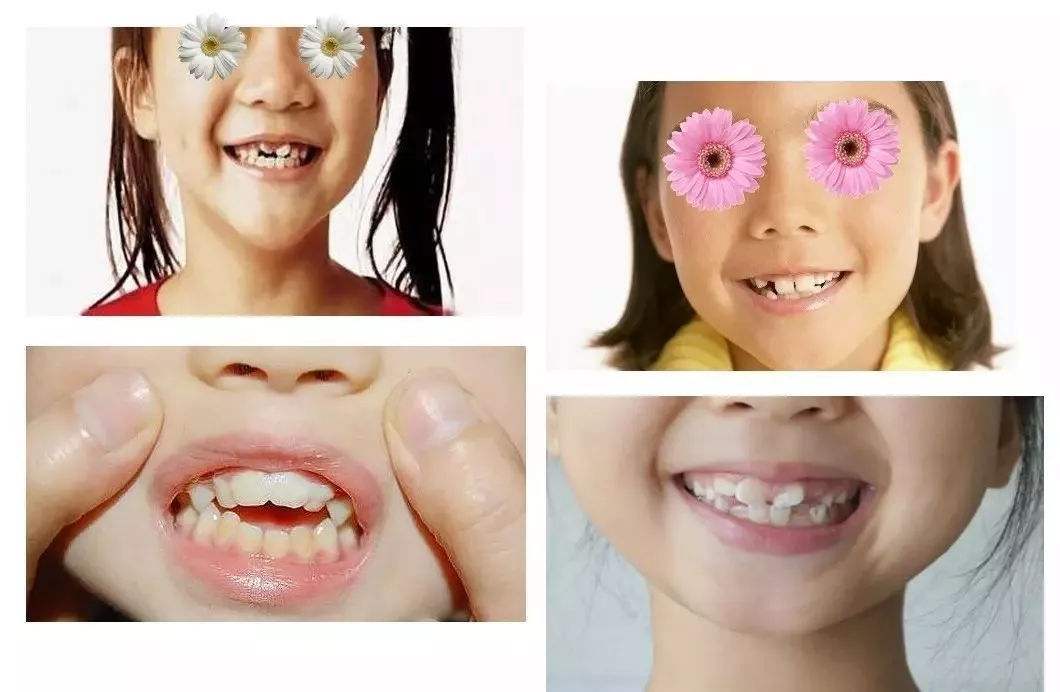 细心的家长发现孩子9岁了牙齿很不整齐,想挽救,觉得孩子年龄比较小