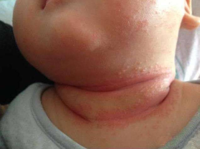 捏积派——夏季宝宝淹脖子,发红又破皮怎么办?如何正确护理_皮肤