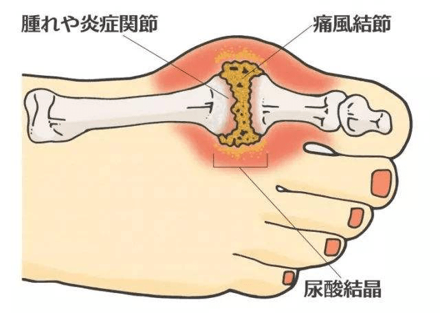 想要降低尿酸廚房中這3樣東西趁早扔尿酸自然降