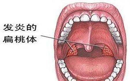 扁桃體切還是不切--聽聽北京玉泉醫院耳鼻喉科申力主任的建議