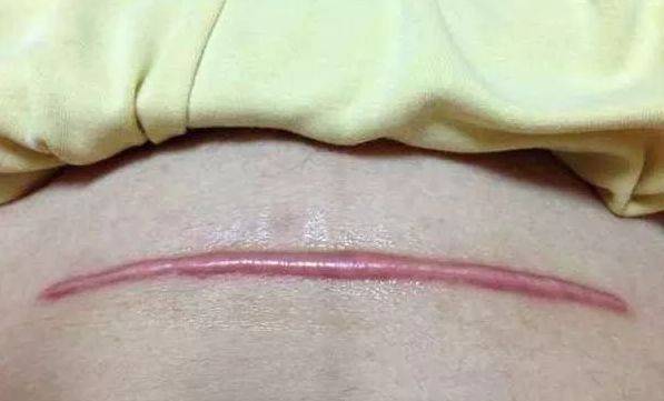 剖宫产顺产后的伤口护理方法不一样要分清