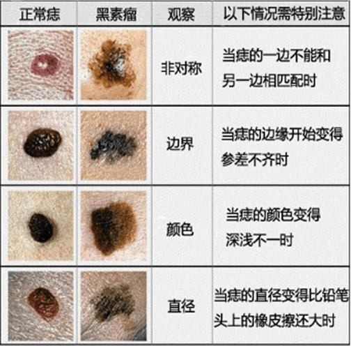 上海長江胎記醫院肖萍痣惡變有哪些症狀呢