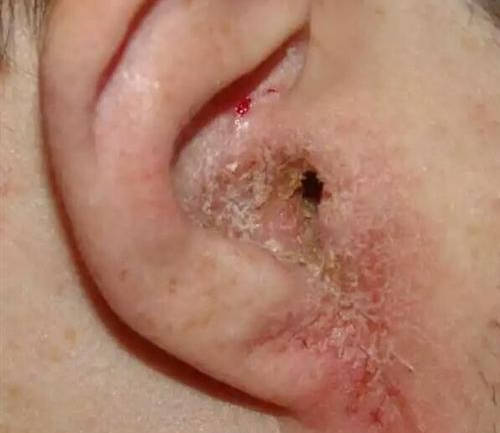 外耳道充血图片