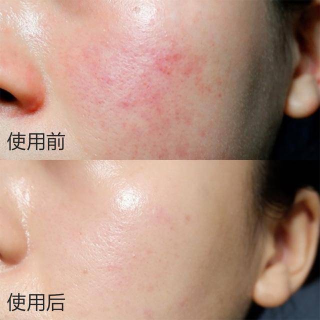 逆袭年轻灯泡肌试试高露同款水感肌赋活精华