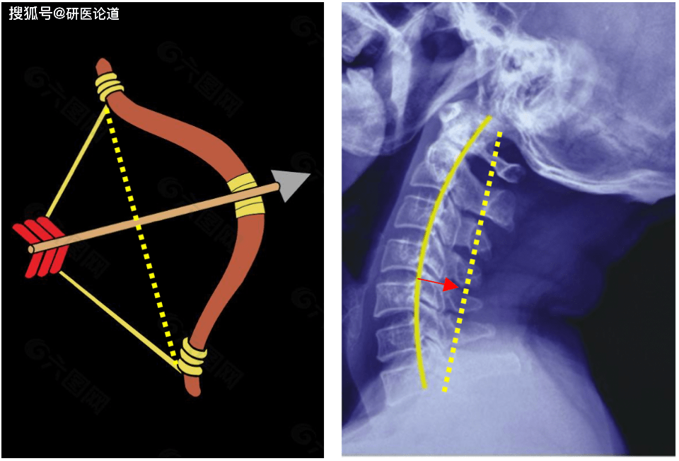 图2,而颈椎就好比是拉开的弓,当椎管减压后,脊髓▲图1,当弓由拉开的