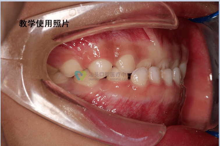 三十而已牙齒矯正有什麼不可以